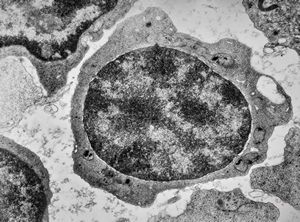 F,21y. | bone marrow - sideroblastic anemia F,21y. | bone marrow - sideroblastic anemia